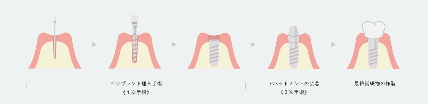 インプラントの手順